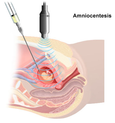 amniocentesis.jpg
