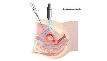 amniocentesis