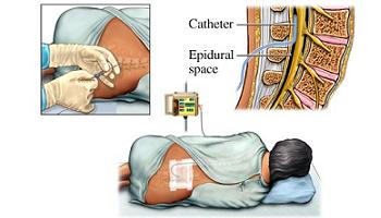 epidural